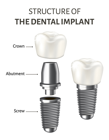 What Are Single Tooth Implants Image