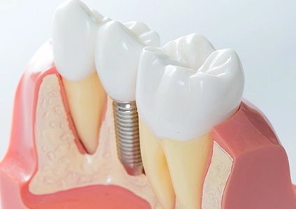 What Are Dental Implants Image