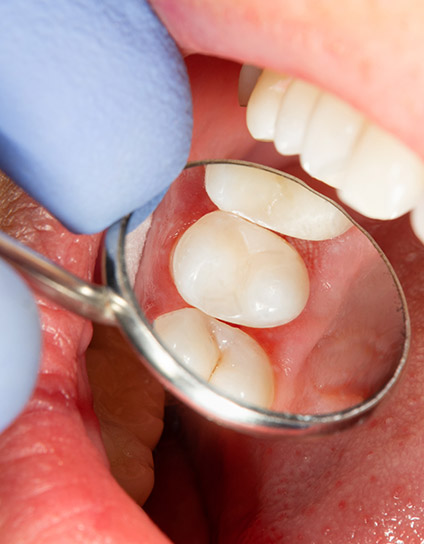 What Are Dental Sealants Image