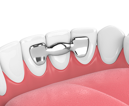 Restore Your Oral Health and Smile with a Fixed Bridge in Bixby Knolls Image